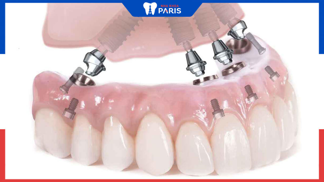 Các phương pháp trồng răng giả nguyên hàm phổ biến nhất